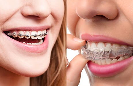 This is the image for the news article titled Braces vs. Invisalign